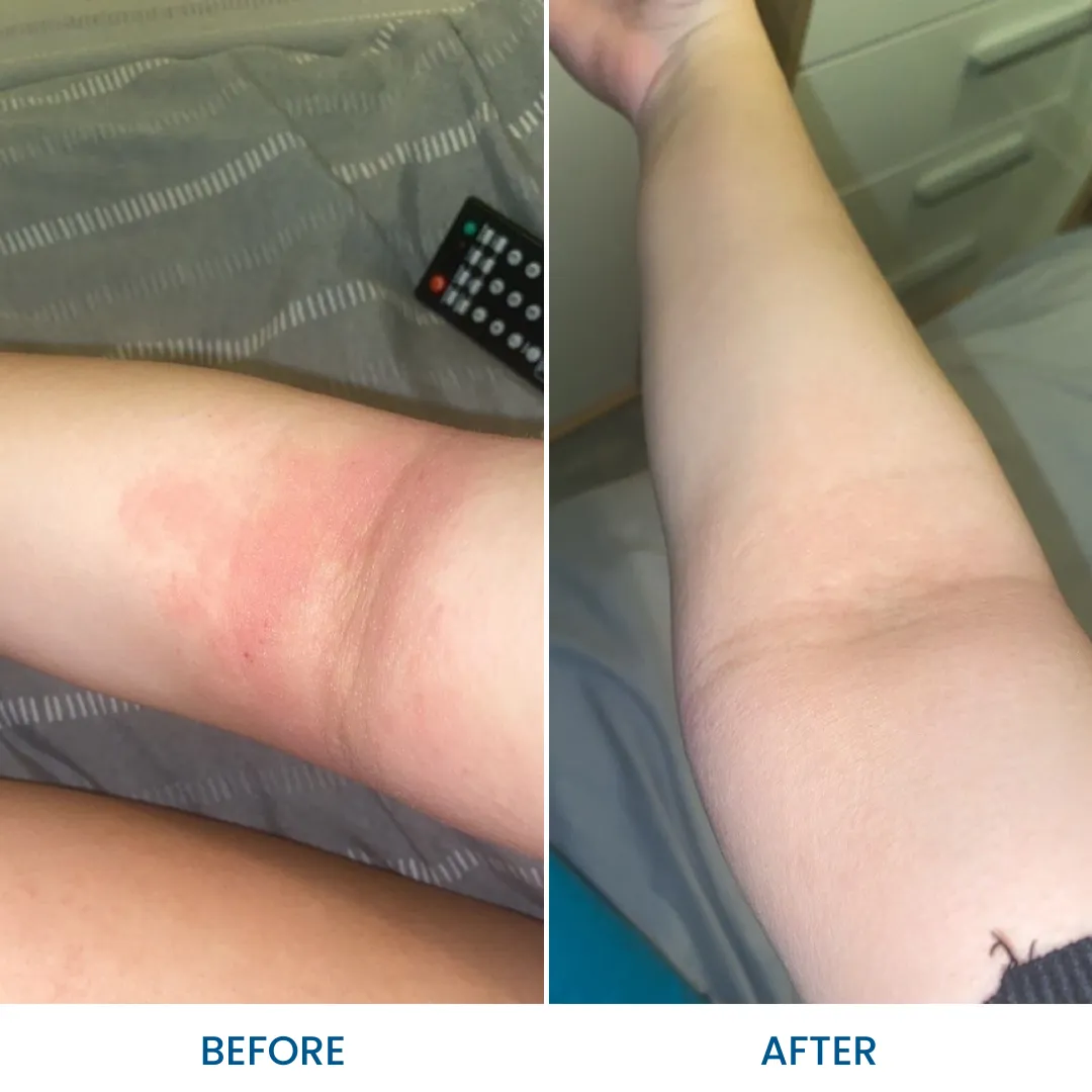 C  Eczema & Dermatitis Cream